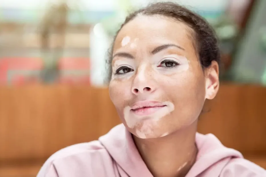 Vitiligo: Causes, Symptoms, and Treatment Options